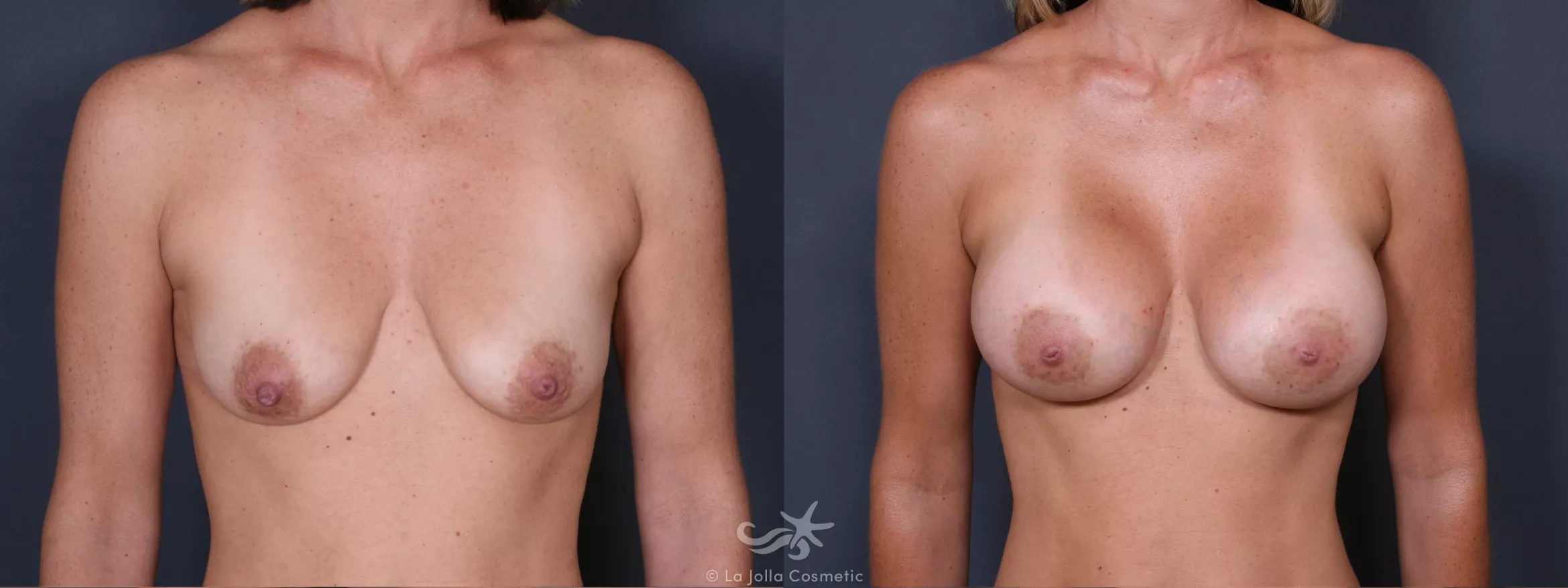 Before & After Breast Augmentation Result 292 Front View in San Diego, CA