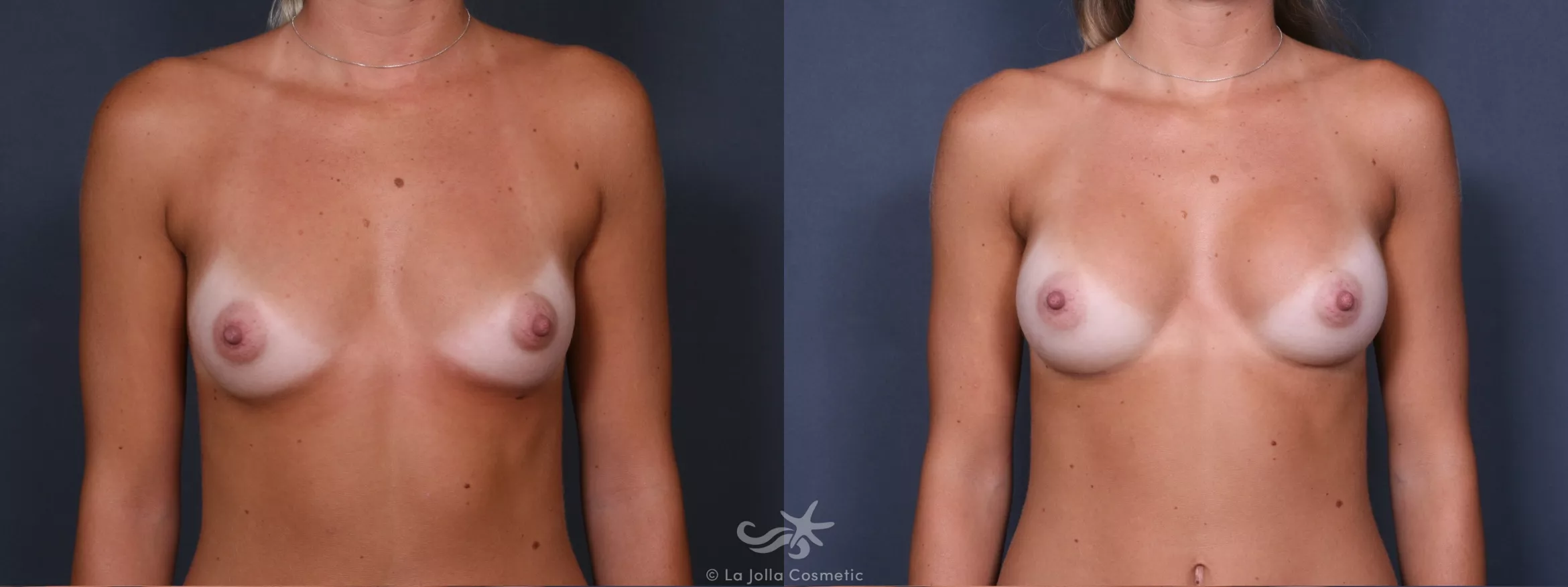 Before & After Breast Augmentation Result 293 Front View in San Diego, CA
