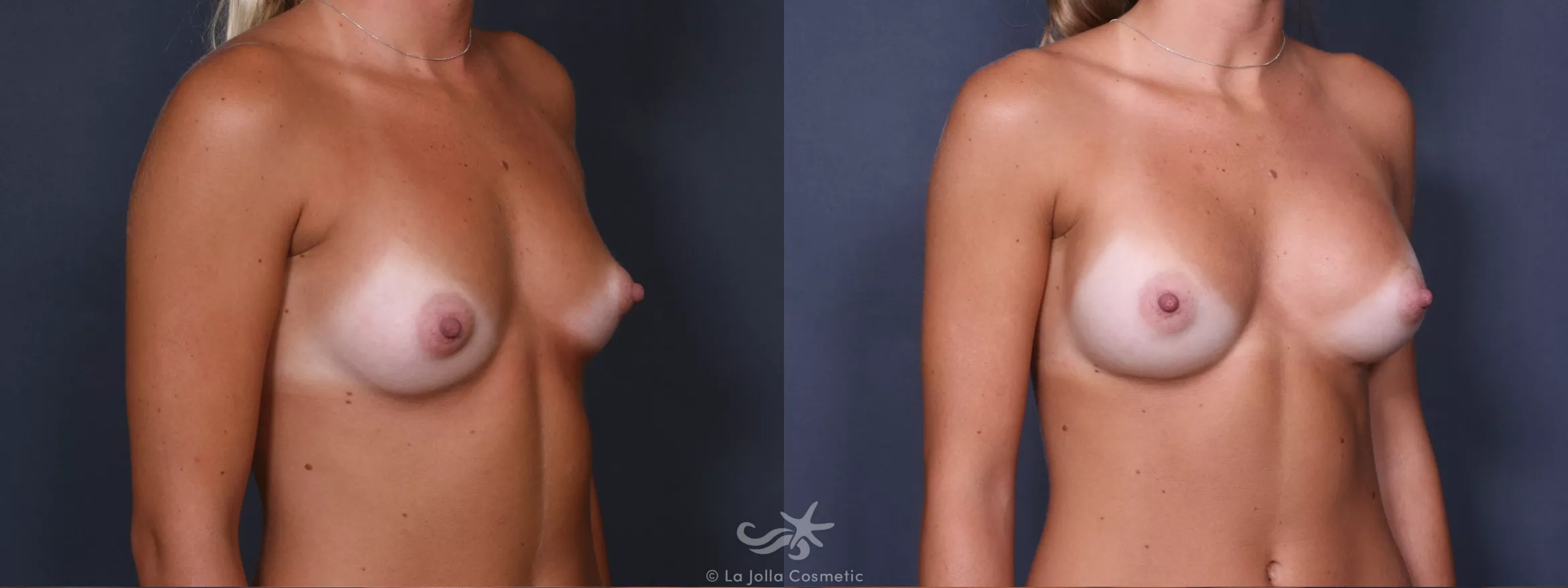 Before & After Breast Augmentation Result 293 Right Oblique View in San Diego, CA