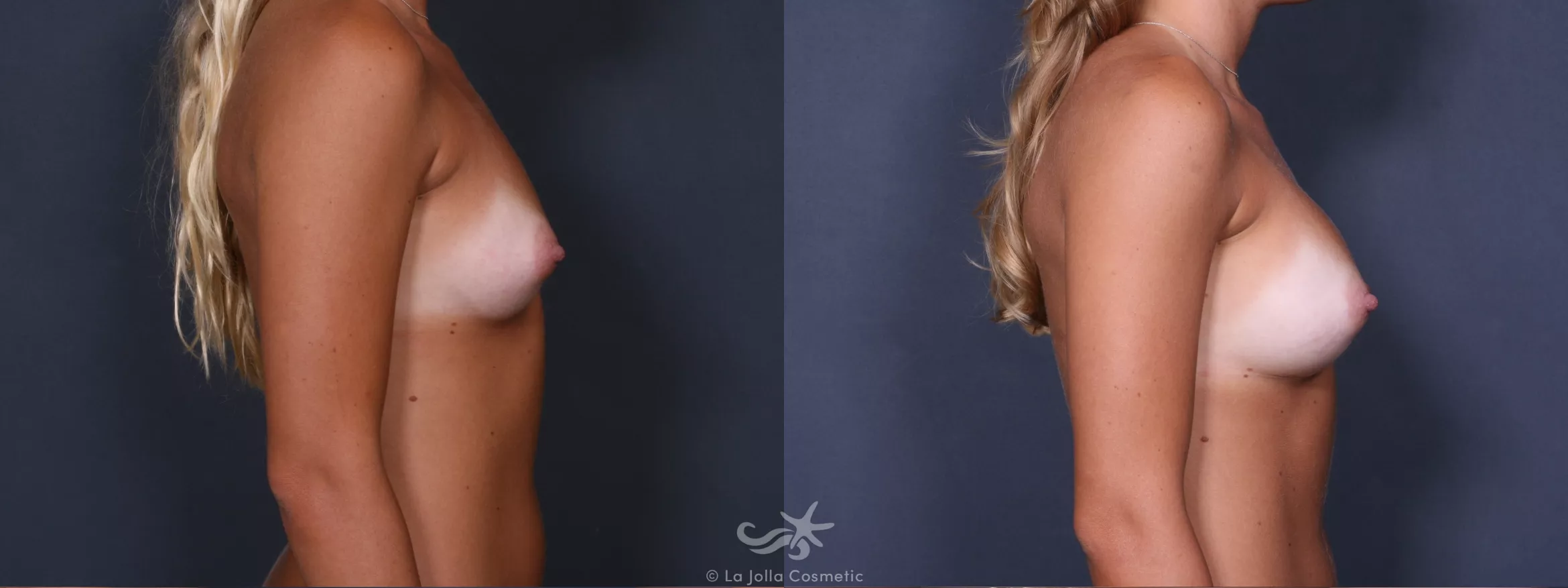 Before & After Breast Augmentation Result 293 Right Side View in San Diego, CA