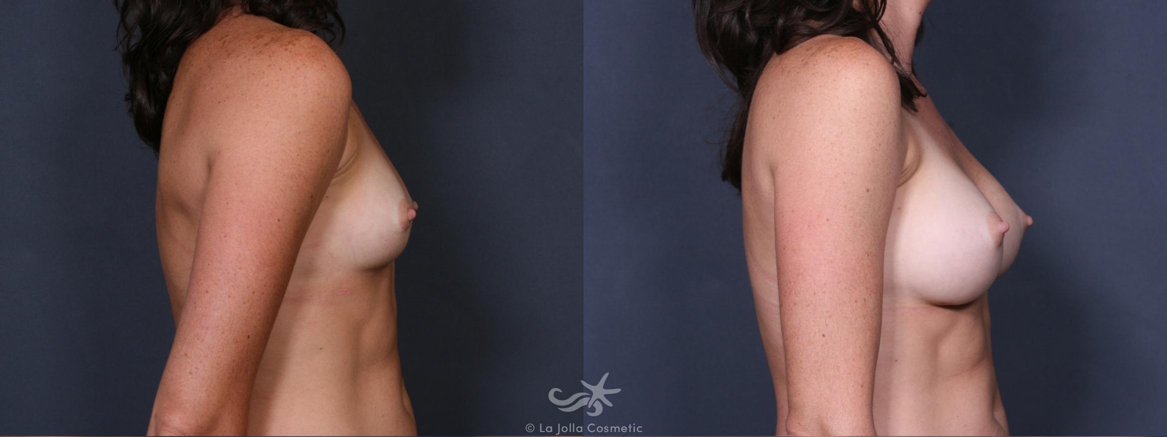 Before & After Breast Augmentation Result 294 Right Side View in San Diego, CA