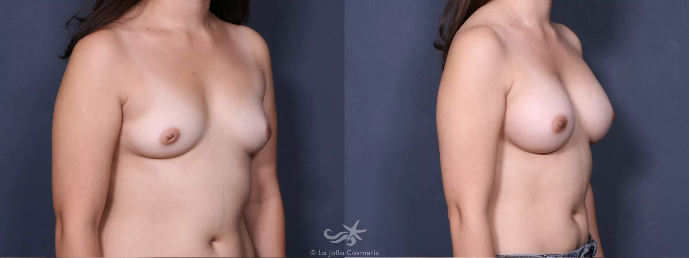 Before & After Breast Augmentation Result 295 Right Oblique View in San Diego, CA