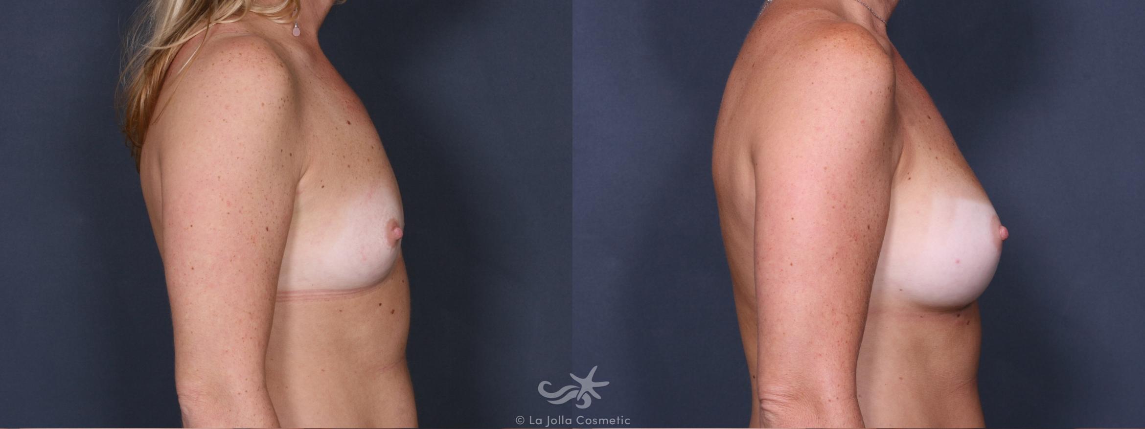 Before & After Breast Augmentation Result 297 Right Side View in San Diego, CA