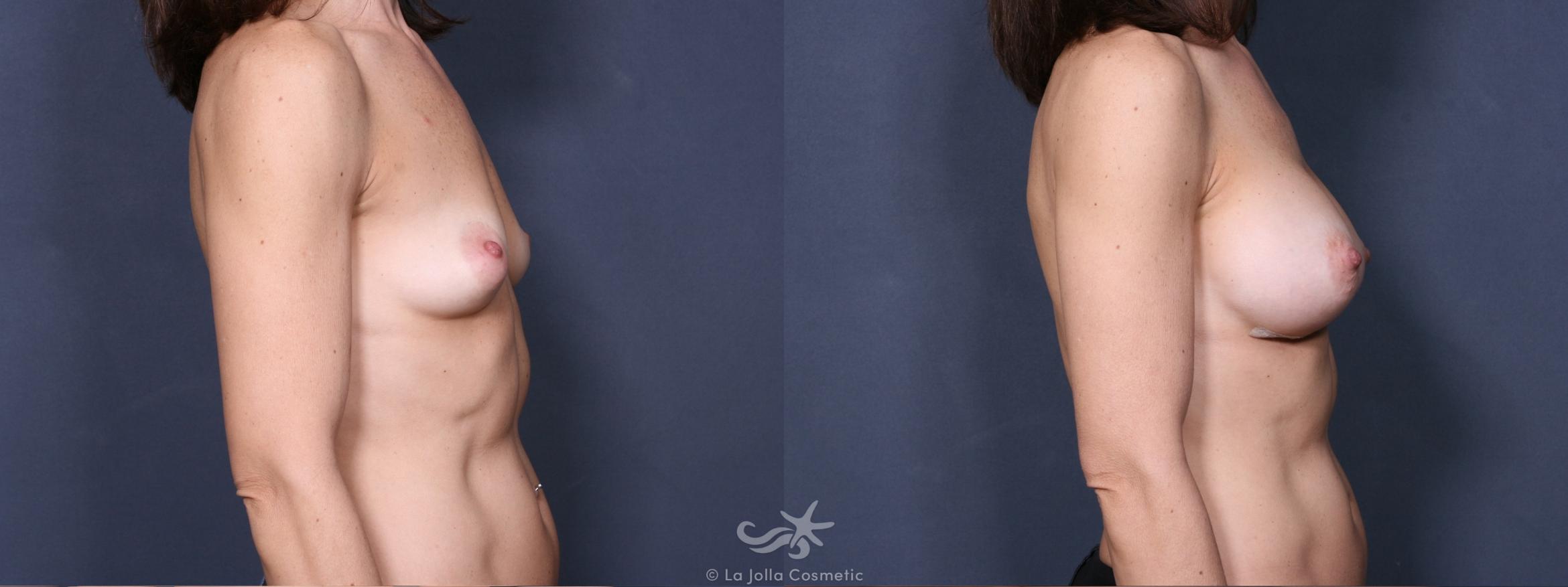Before & After Breast Augmentation Result 300 Right Side View in San Diego, CA
