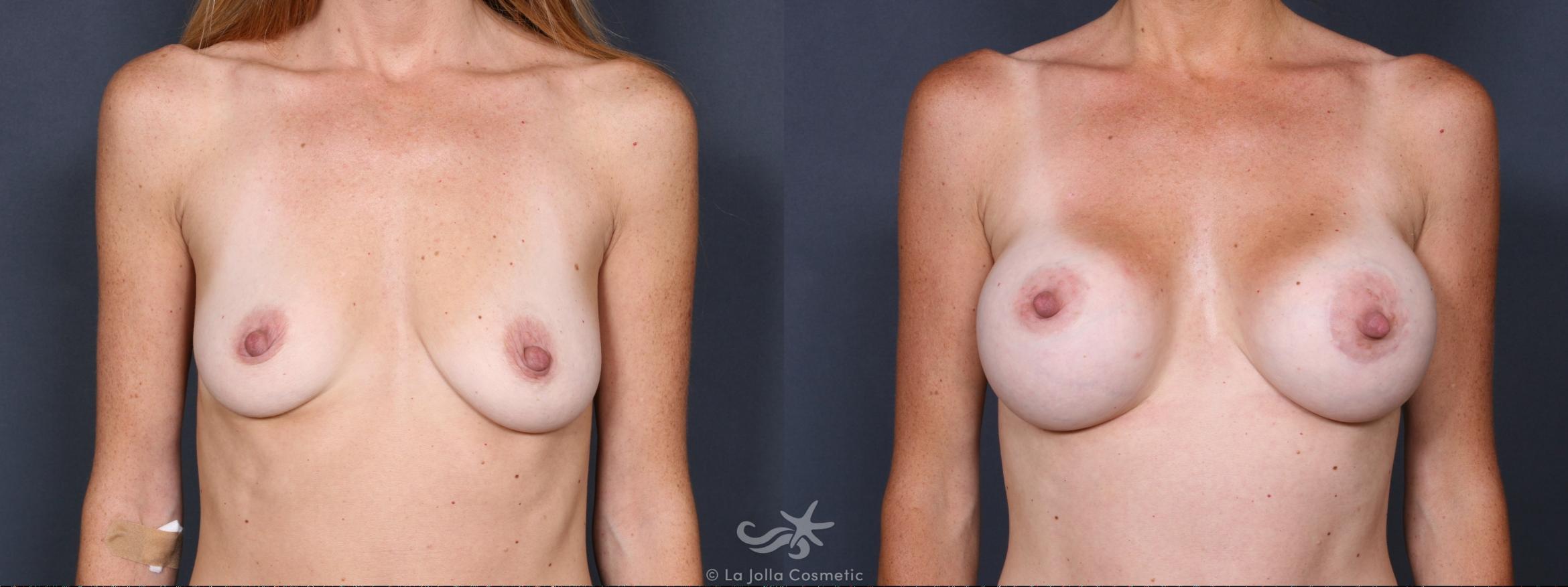 Before & After Breast Augmentation Result 302 Front View in San Diego, CA