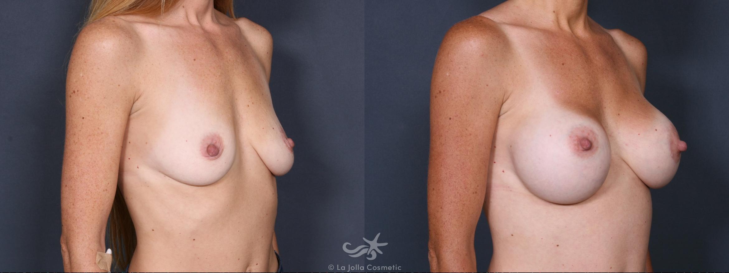 Before & After Breast Augmentation Result 302 Right Oblique View in San Diego, CA