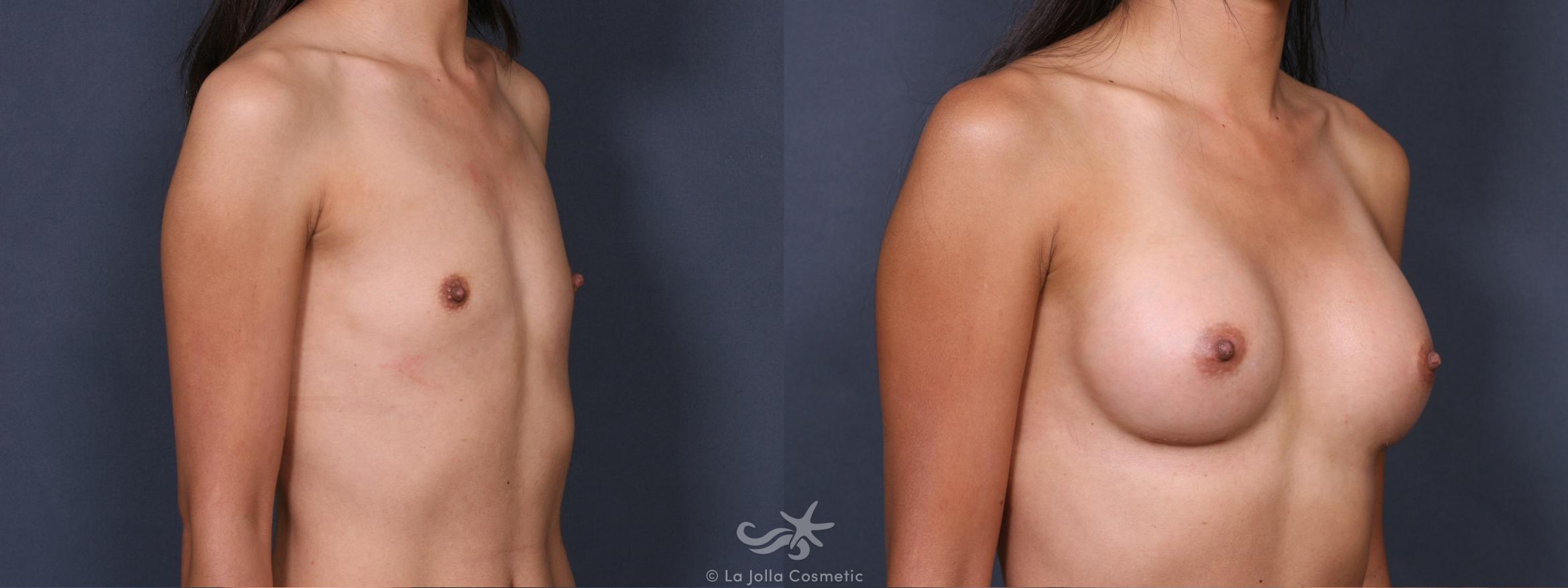 Before & After Breast Augmentation Result 303 Right Oblique View in San Diego, CA