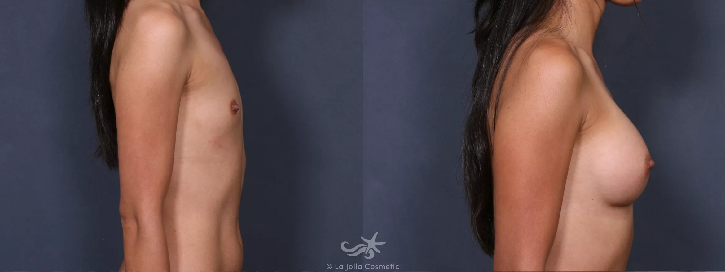Before & After Breast Augmentation Result 303 Right Side View in San Diego, CA