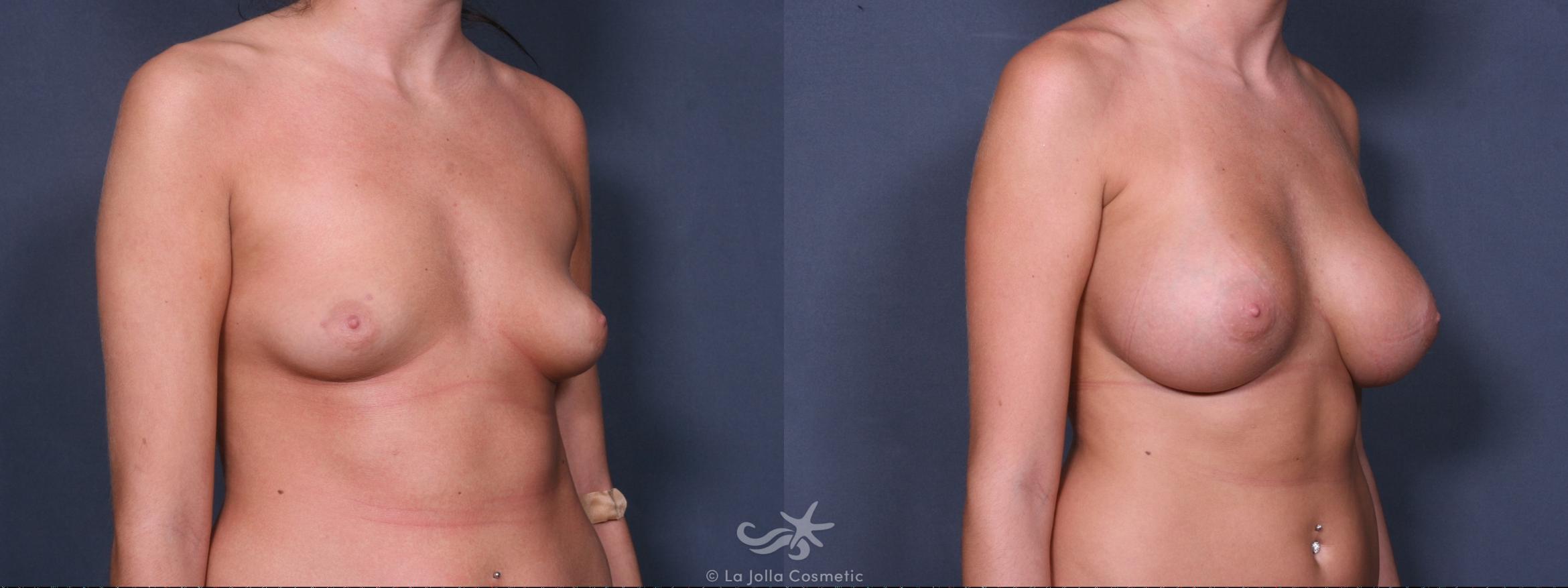 Before & After Breast Augmentation Result 305 Right Oblique View in San Diego, CA