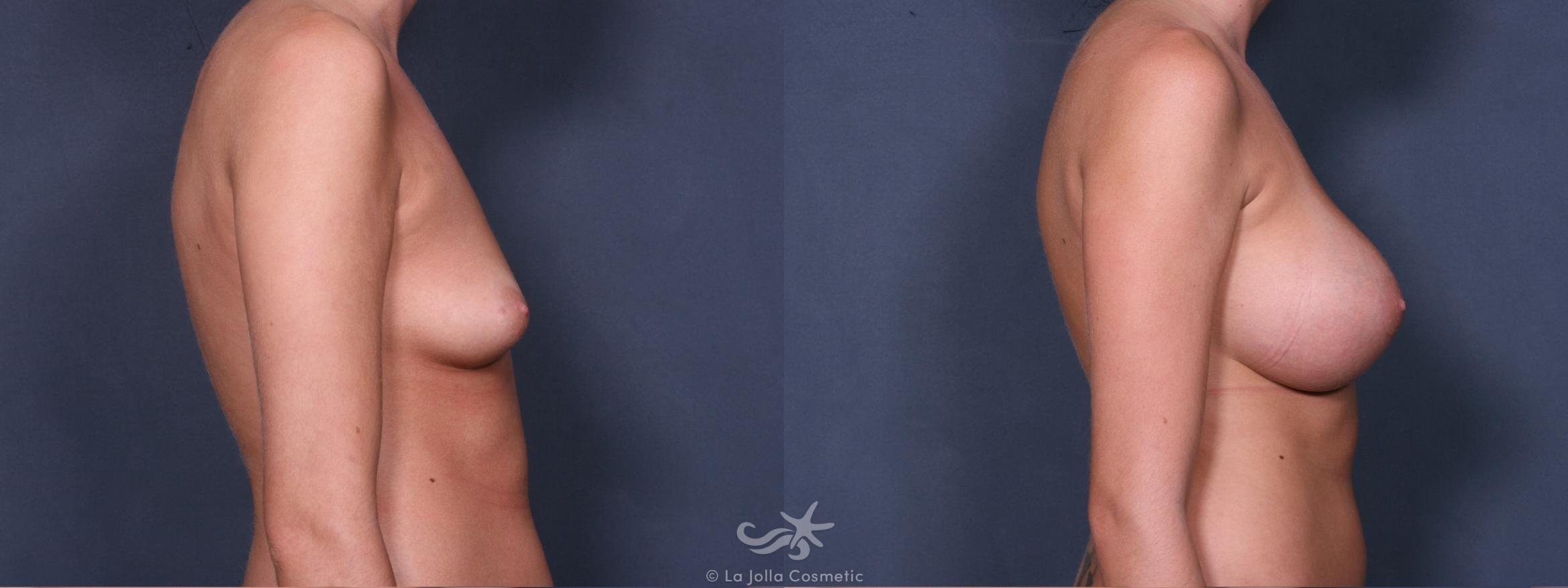 Before & After Breast Augmentation Result 305 Right Side View in San Diego, CA