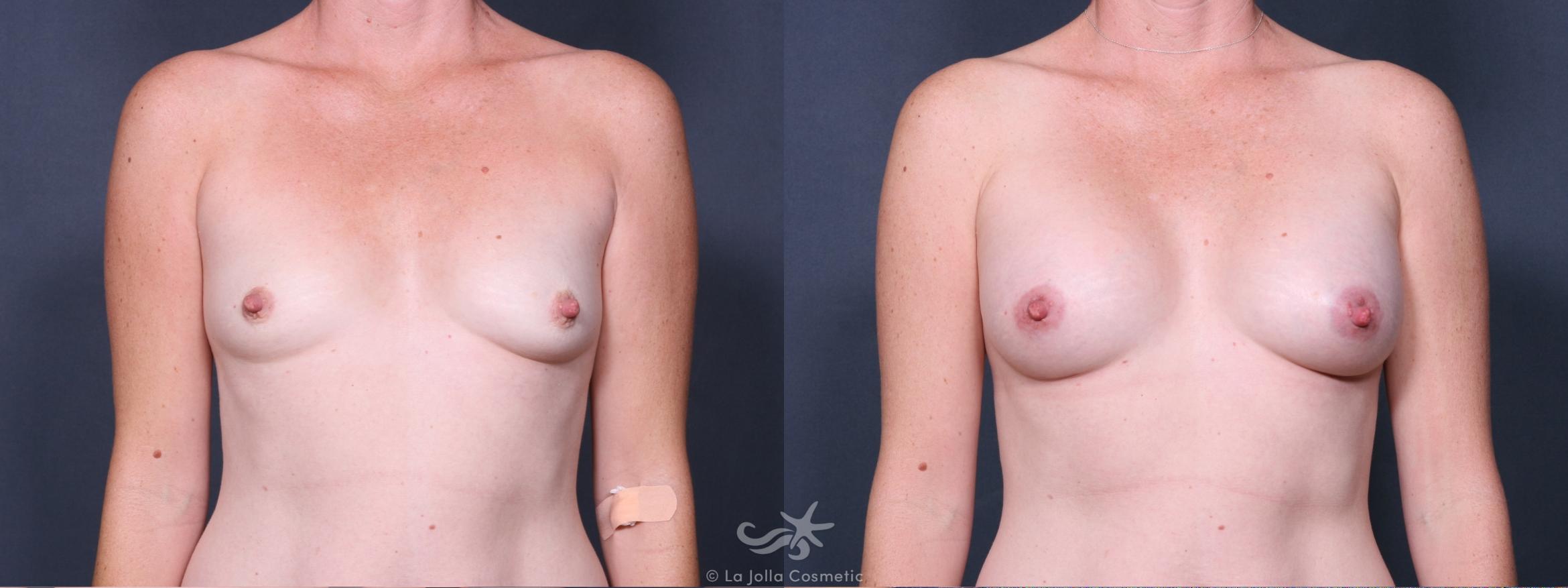 Before & After Breast Augmentation Result 308 Front View in San Diego, CA