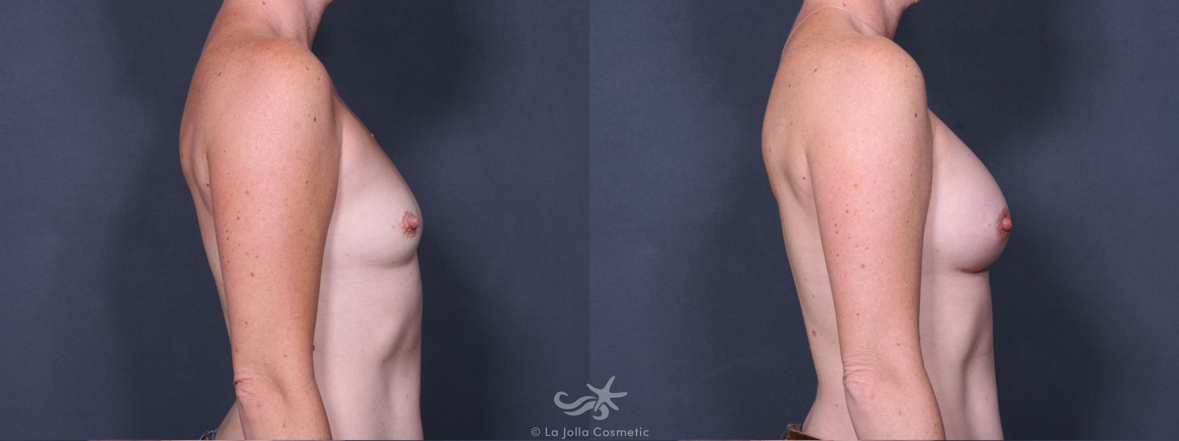 Before & After Breast Augmentation Result 308 Right Side View in San Diego, CA