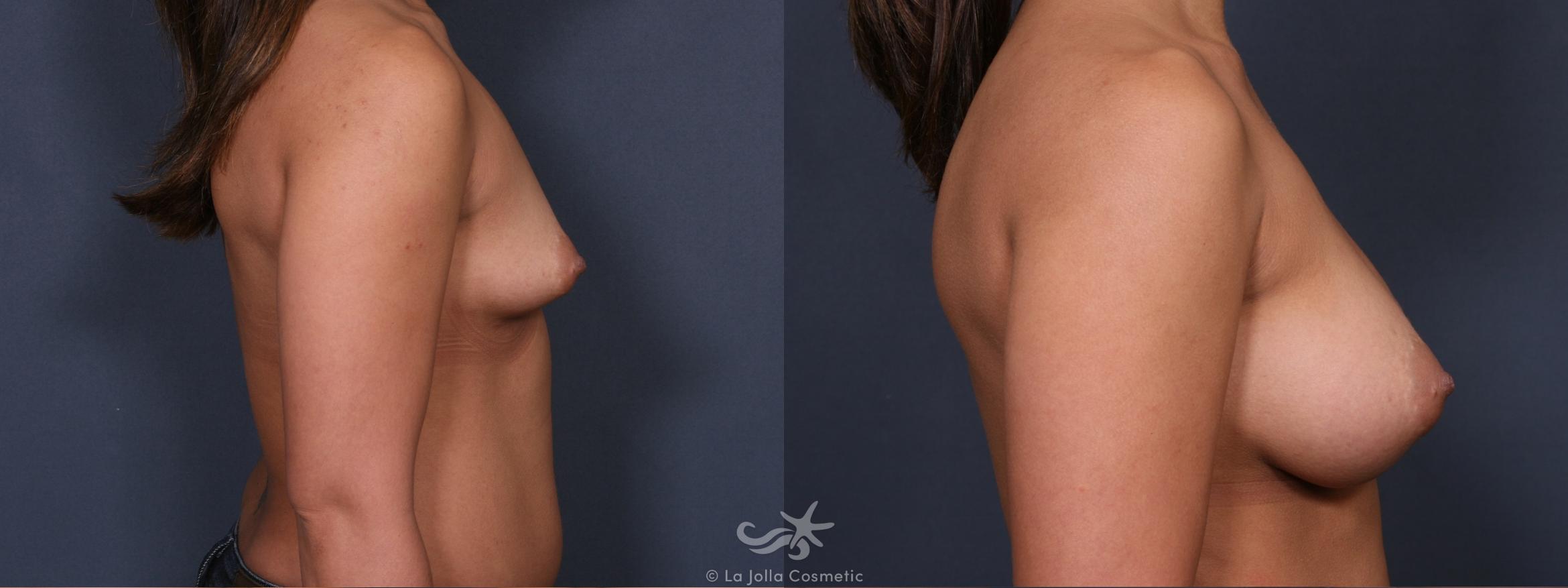 Before & After Breast Augmentation Result 309 Right Side View in San Diego, CA