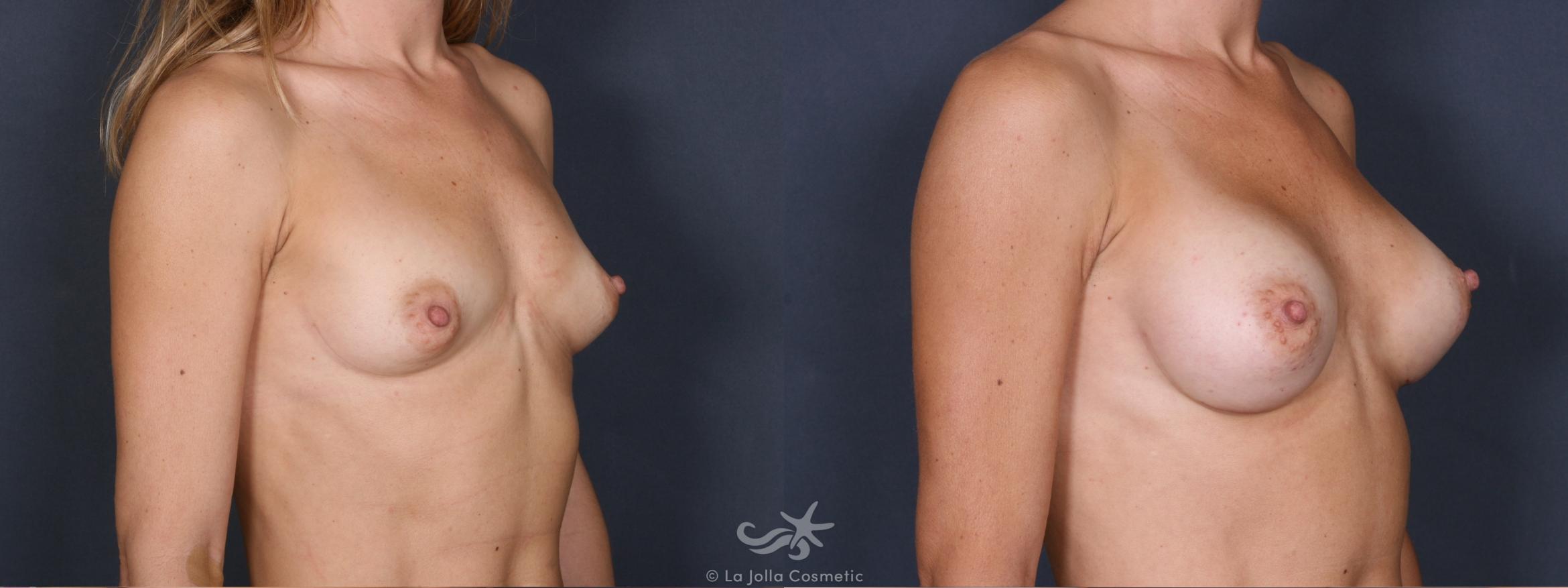 Before & After Breast Augmentation Result 313 Right Oblique View in San Diego, CA