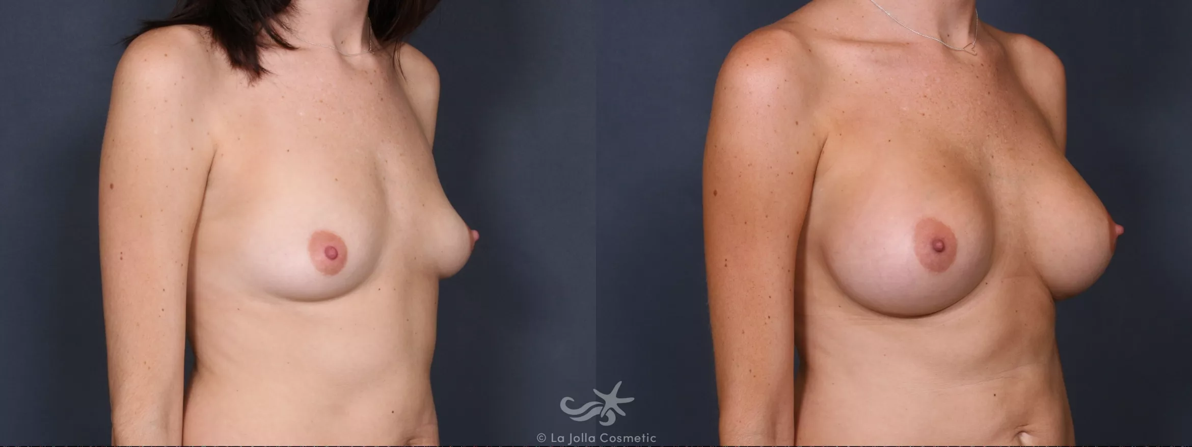 Before & After Breast Augmentation Result 314 Right Oblique View in San Diego, CA