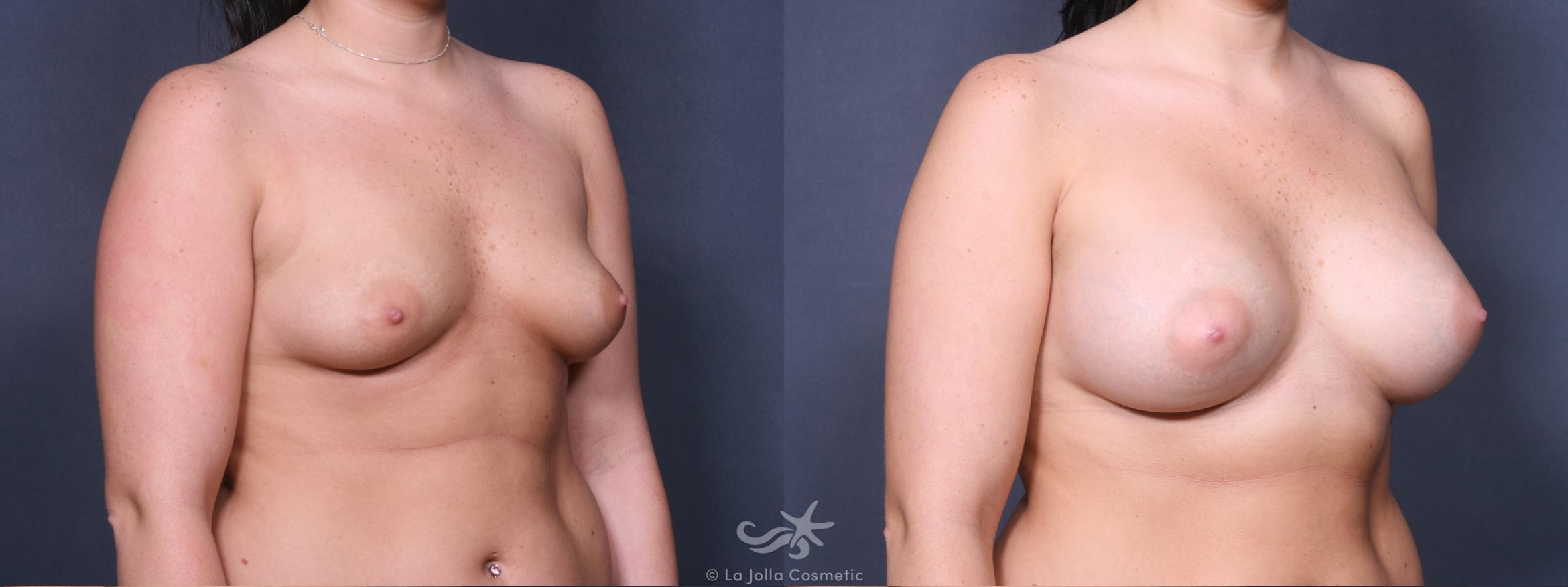 Before & After Breast Augmentation Result 316 Right Oblique View in San Diego, CA