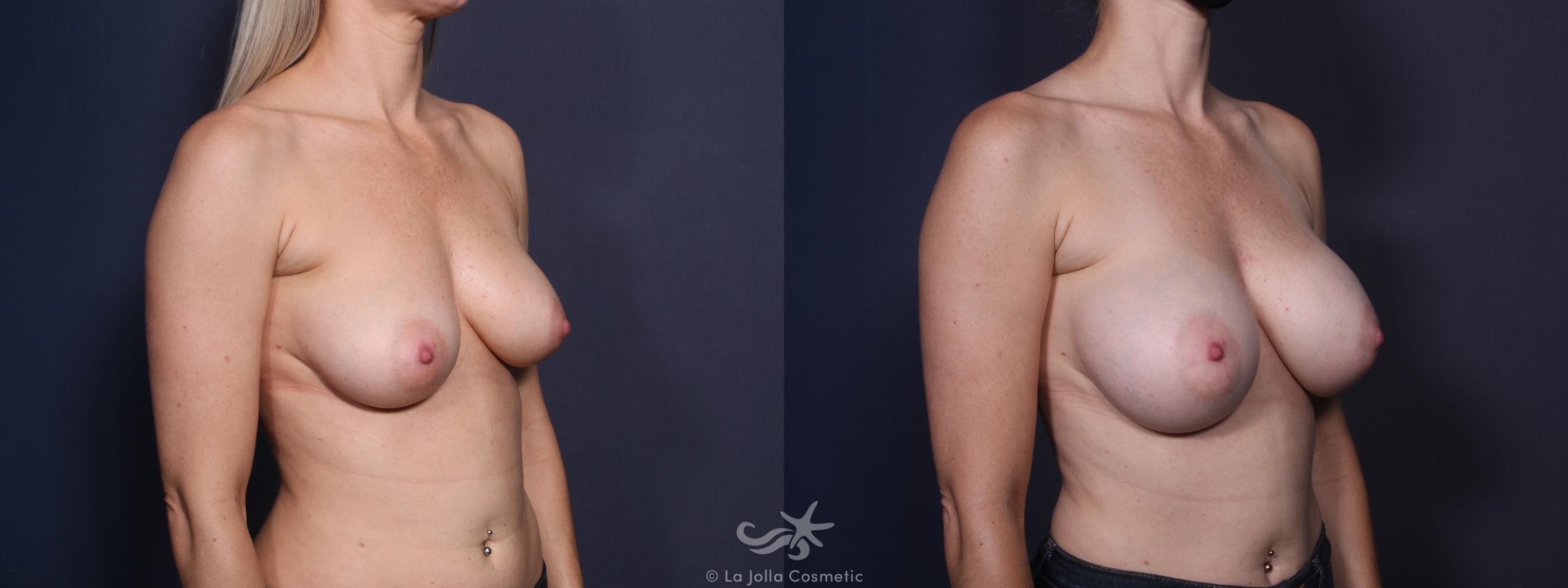 Before & After Breast Augmentation Result 32 Right Oblique View in San Diego, CA
