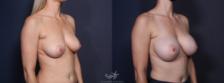 Before & After Breast Augmentation Result 32 Right Oblique View in San Diego, Carlsbad, CA