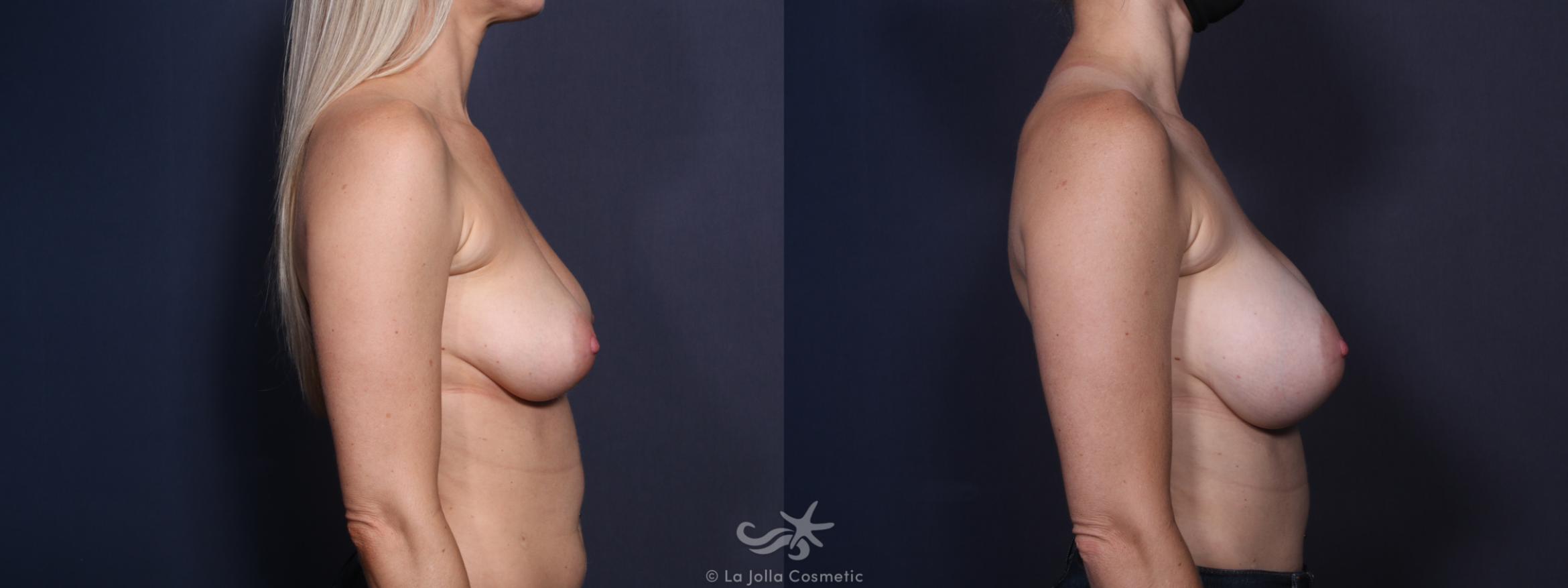 Before & After Breast Augmentation Result 32 Right Side View in San Diego, CA