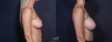 Before & After Breast Augmentation Result 32 Right Side View in San Diego, Carlsbad, CA