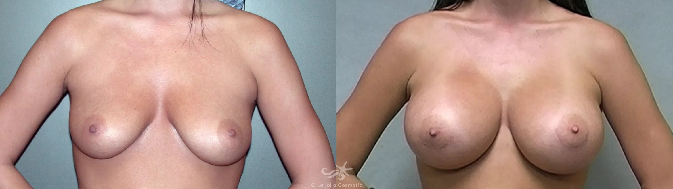 Before & After Breast Augmentation Result 321 Front View in San Diego, CA