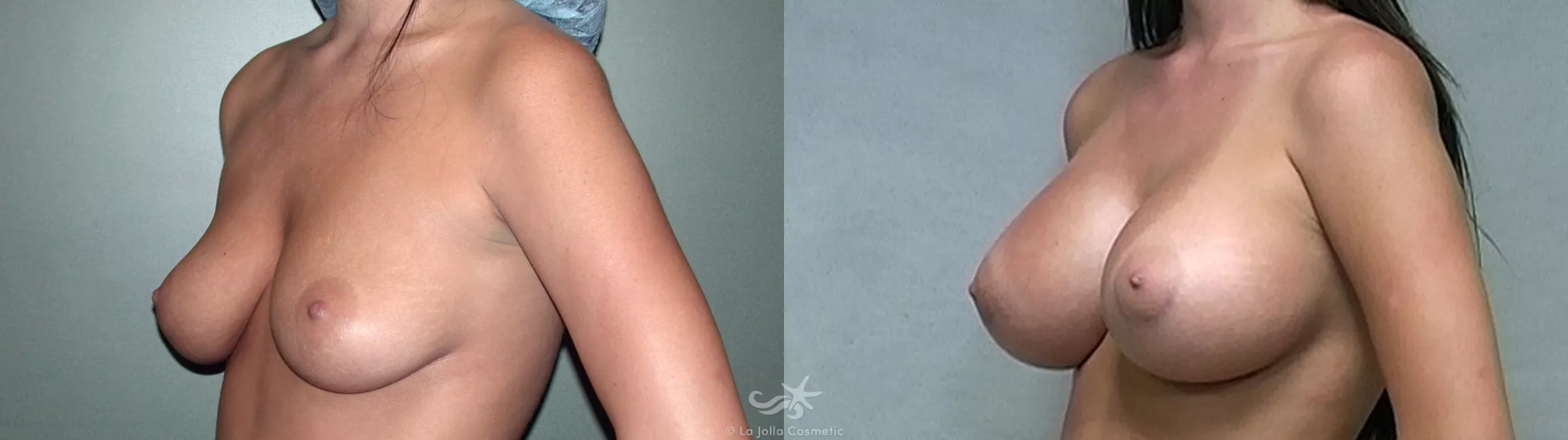 Before & After Breast Augmentation Result 321 Left Oblique View in San Diego, CA