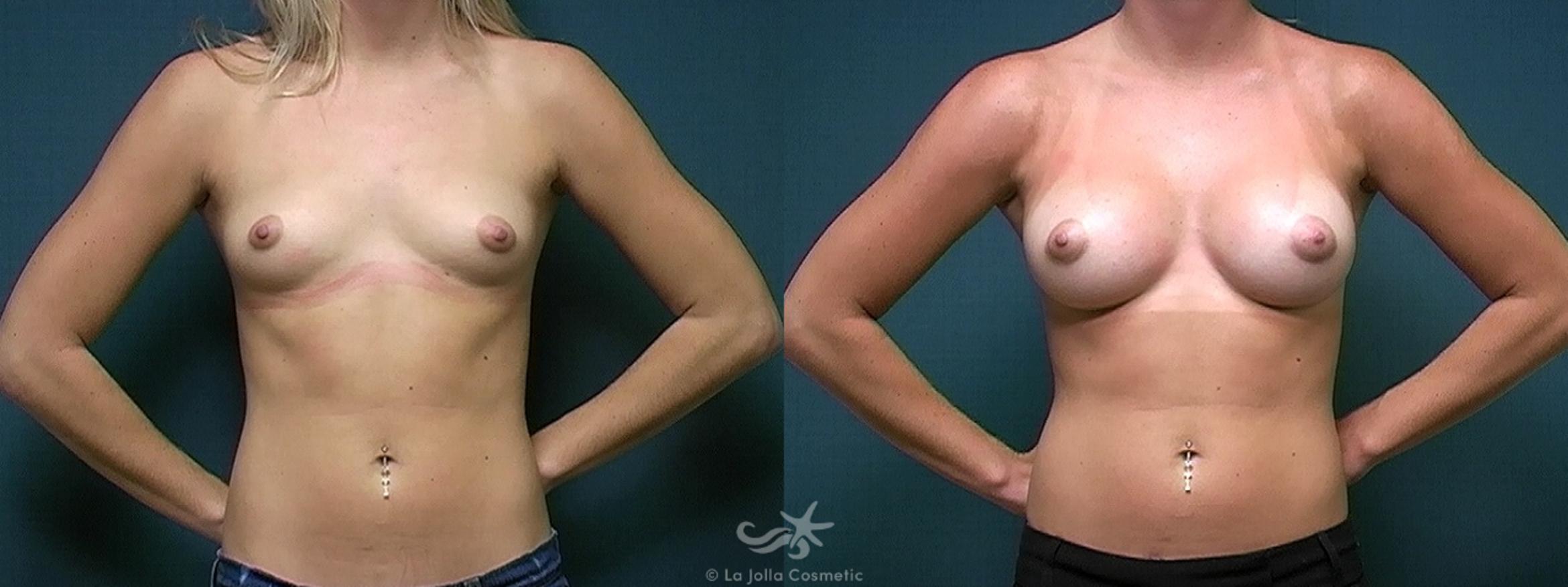 Before & After Breast Augmentation Result 328 Front View in San Diego, CA