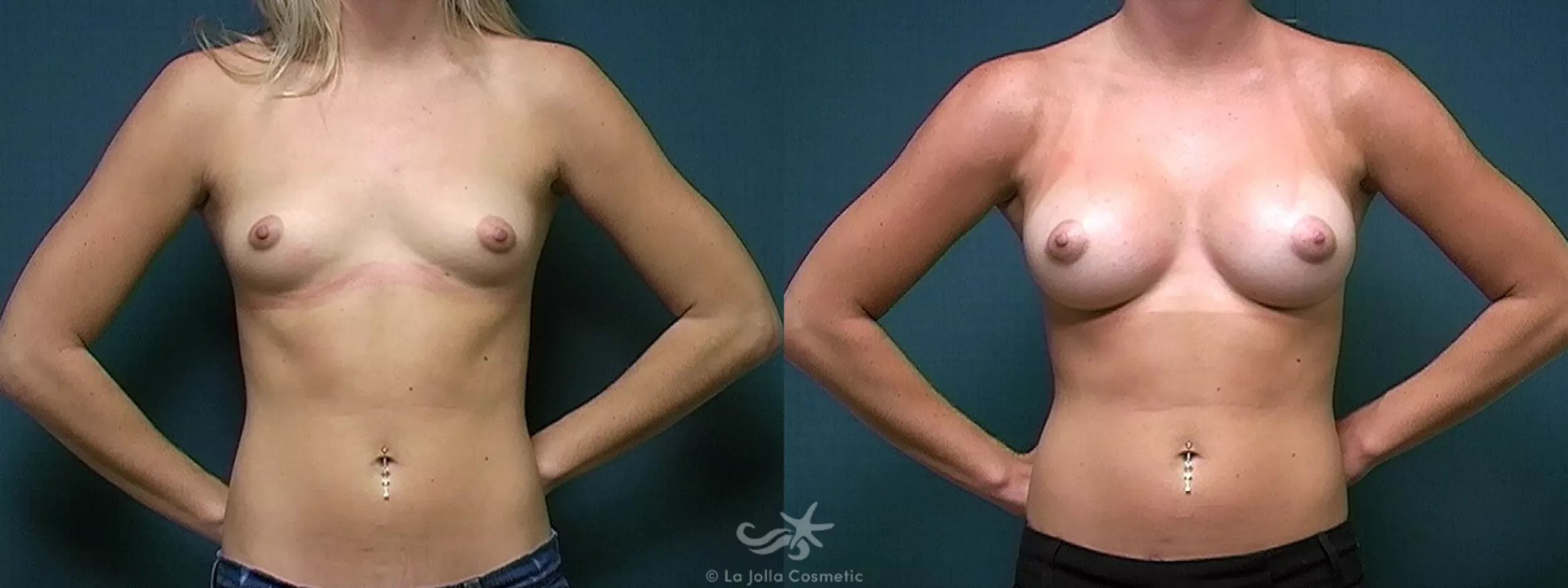 Before & After Breast Augmentation Result 328 Front View in San Diego, CA