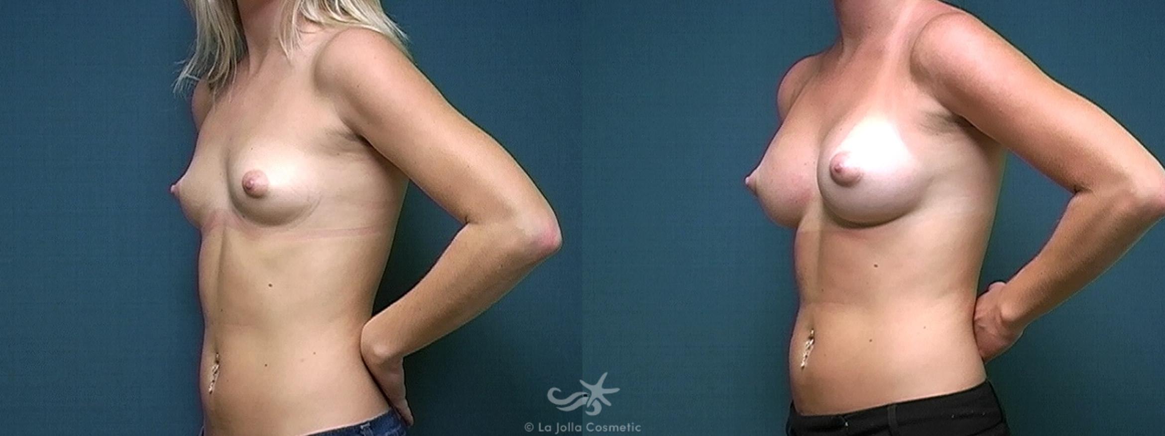 Before & After Breast Augmentation Result 328 Left Oblique View in San Diego, CA