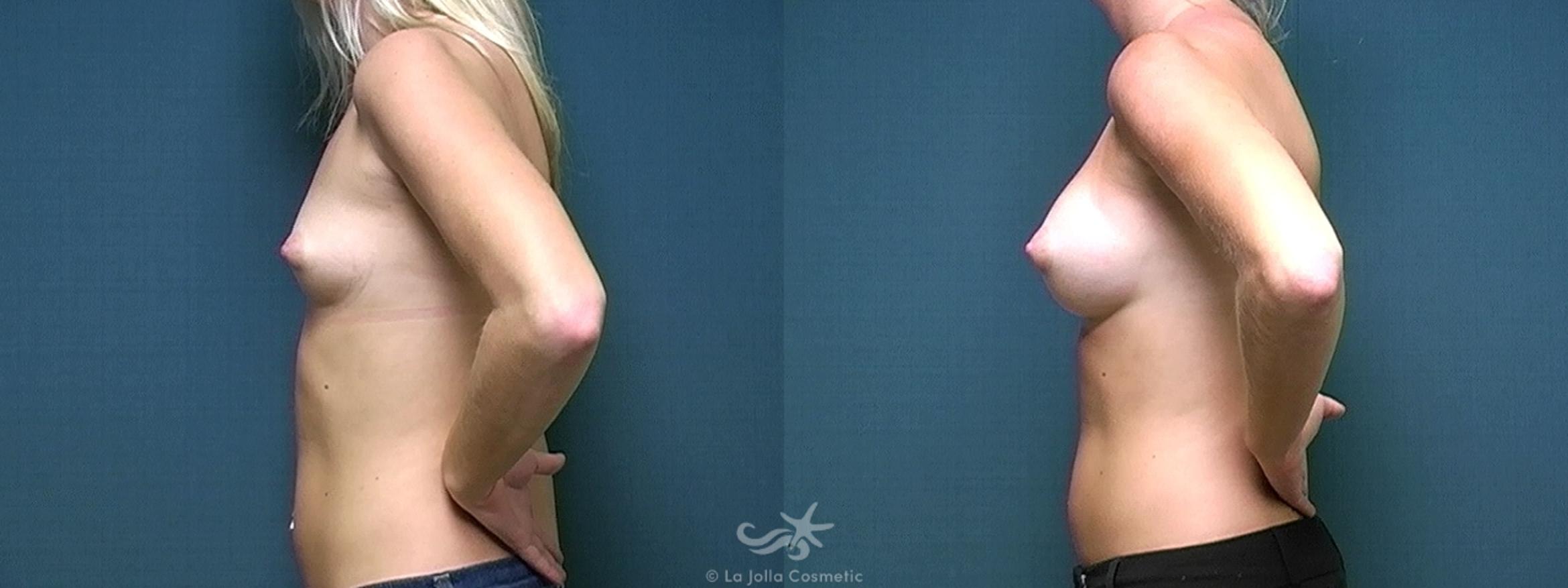 Before & After Breast Augmentation Result 328 Left Side View in San Diego, CA