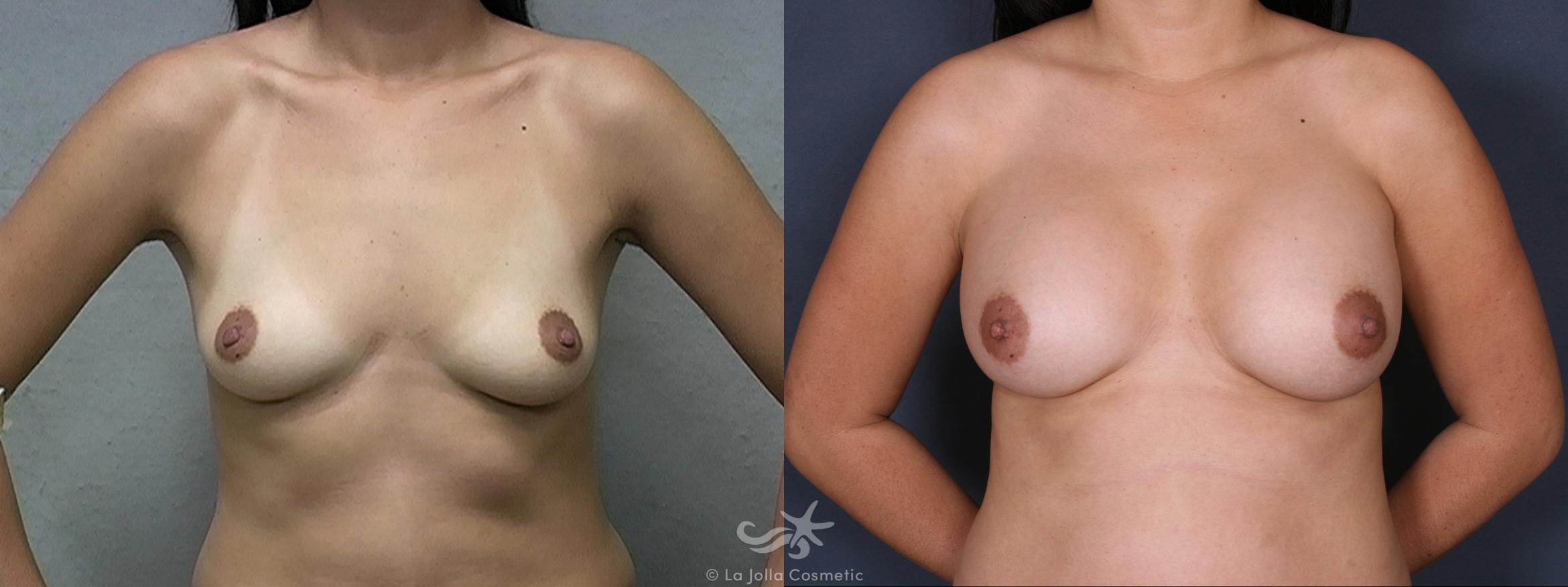 Before & After Breast Augmentation Result 330 Front View in San Diego, CA