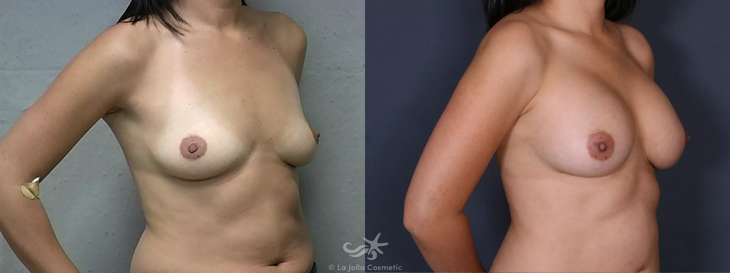 Before & After Breast Augmentation Result 330 Right Oblique View in San Diego, CA