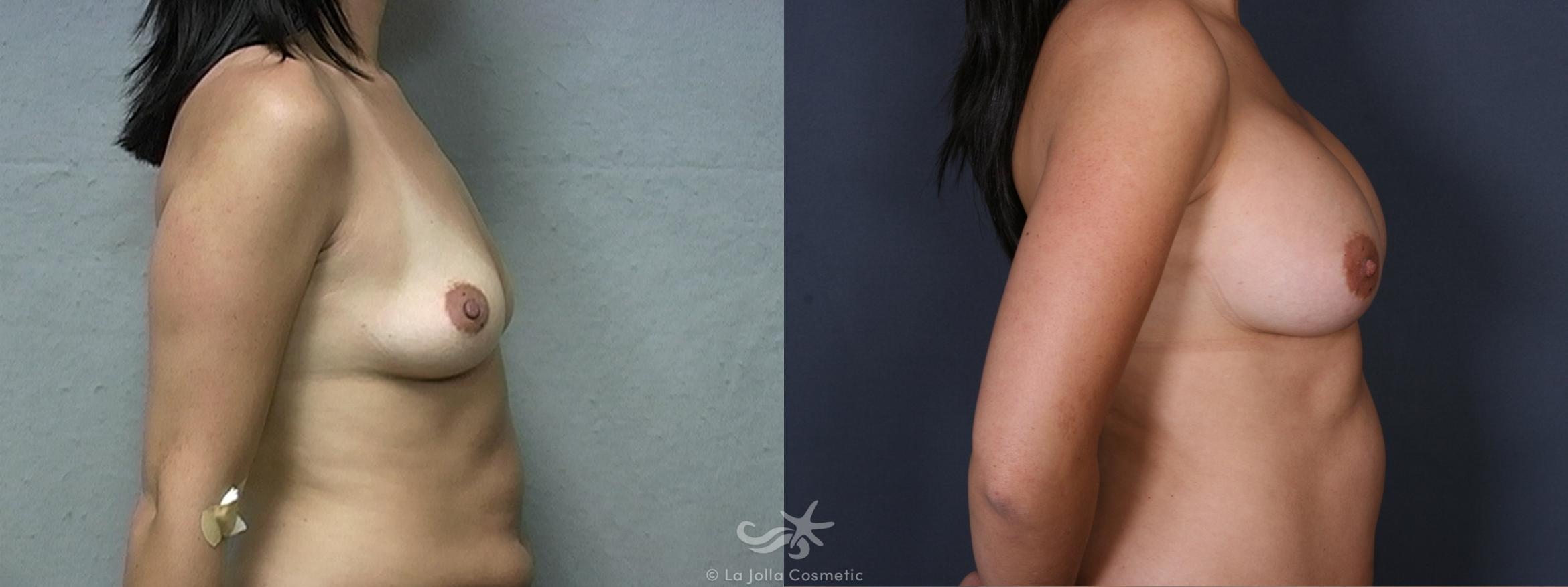 Before & After Breast Augmentation Result 330 Right Side View in San Diego, CA