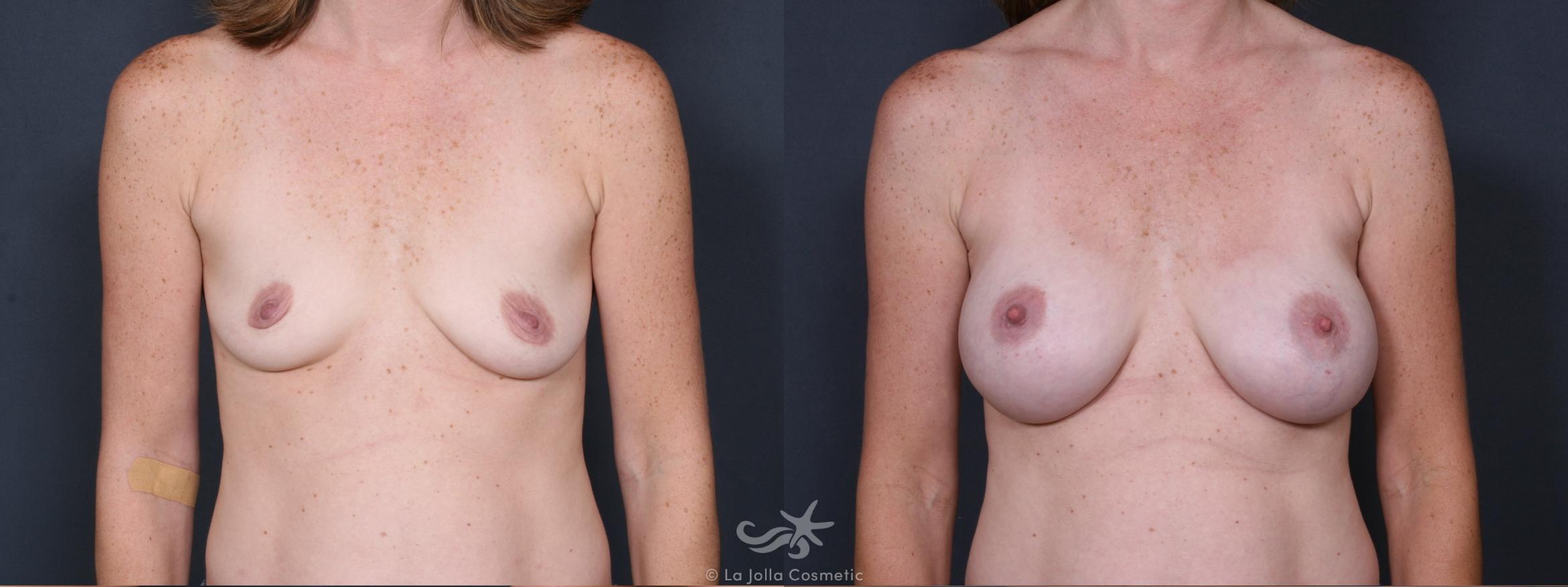Before & After Breast Augmentation Result 331 Front View in San Diego, CA