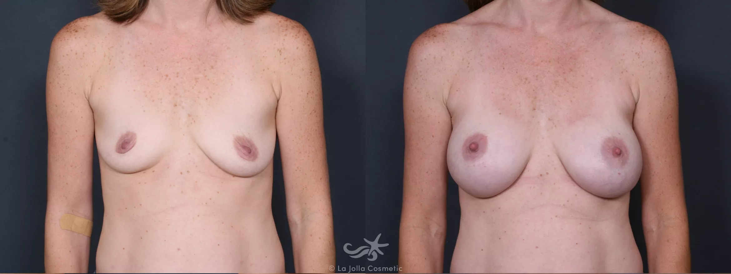 Before & After Breast Augmentation Result 331 Front View in San Diego, CA