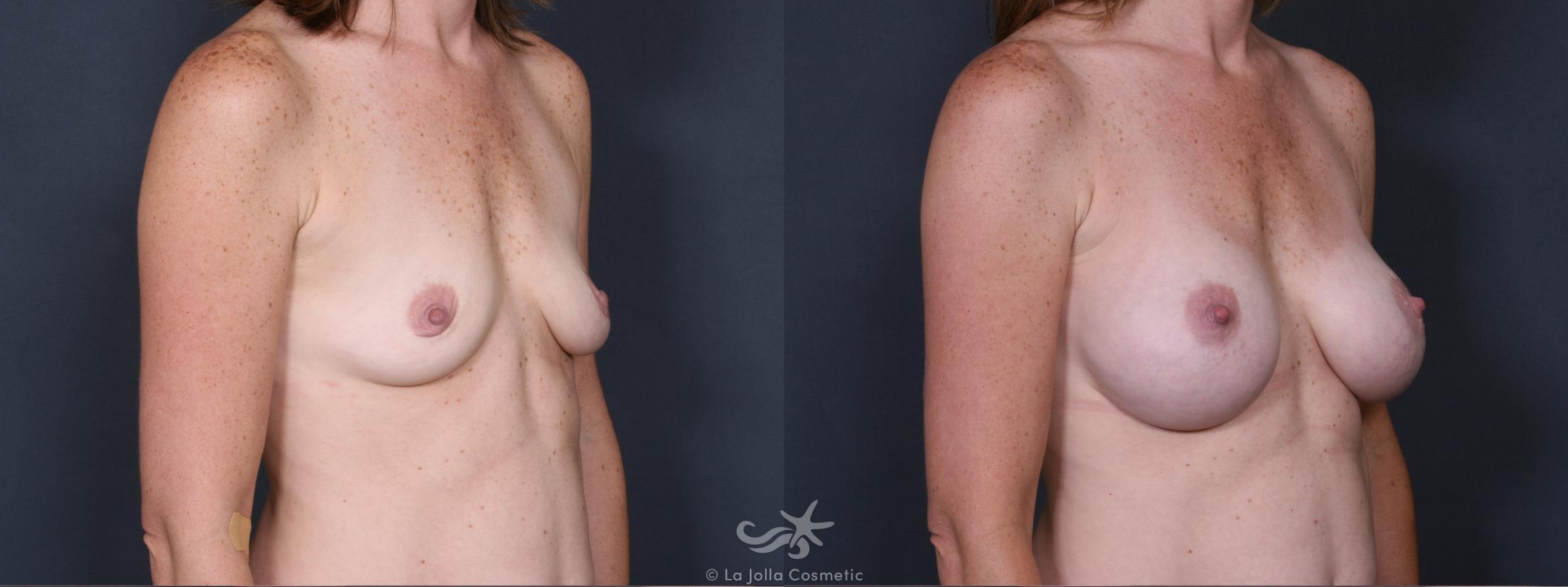 Before & After Breast Augmentation Result 331 Right Oblique View in San Diego, CA