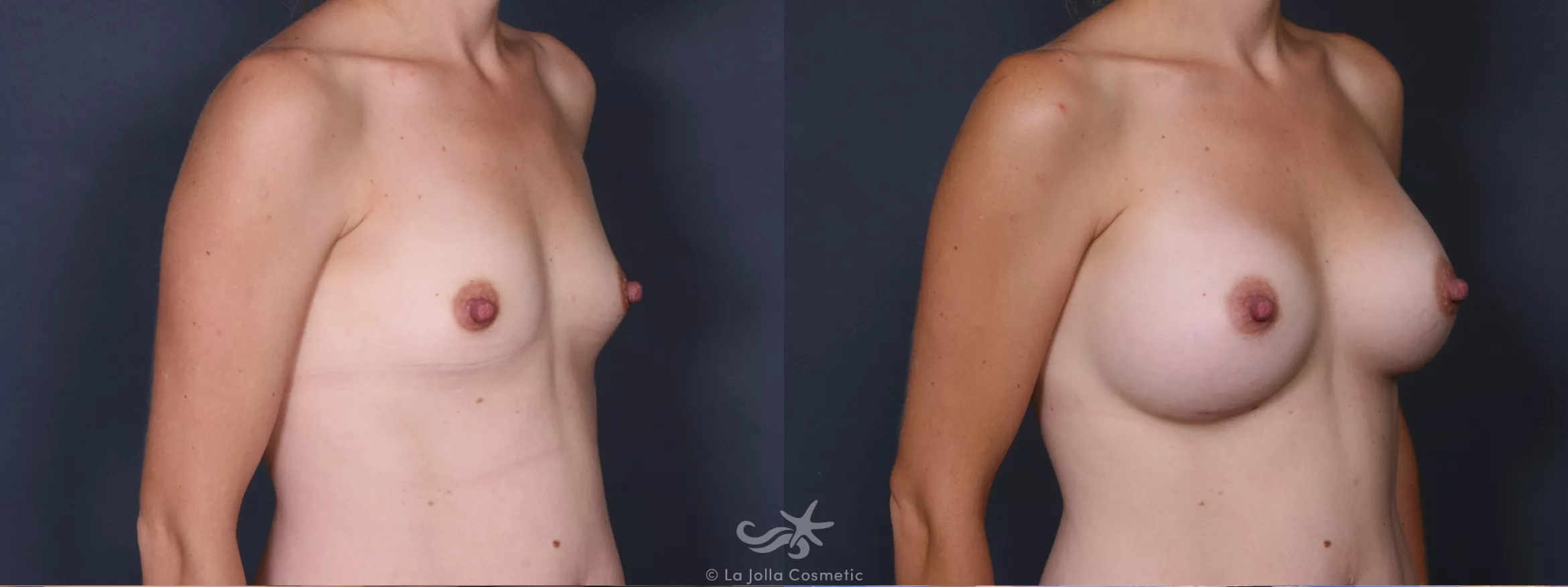Before & After Breast Augmentation Result 332 Right Oblique View in San Diego, CA