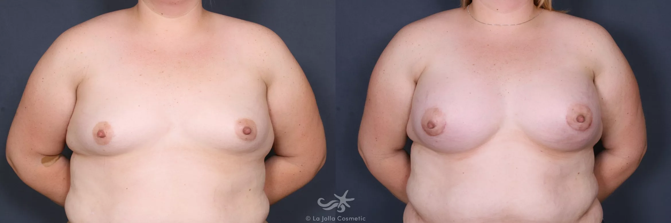 Before & After Breast Augmentation Result 333 Front View in San Diego, CA