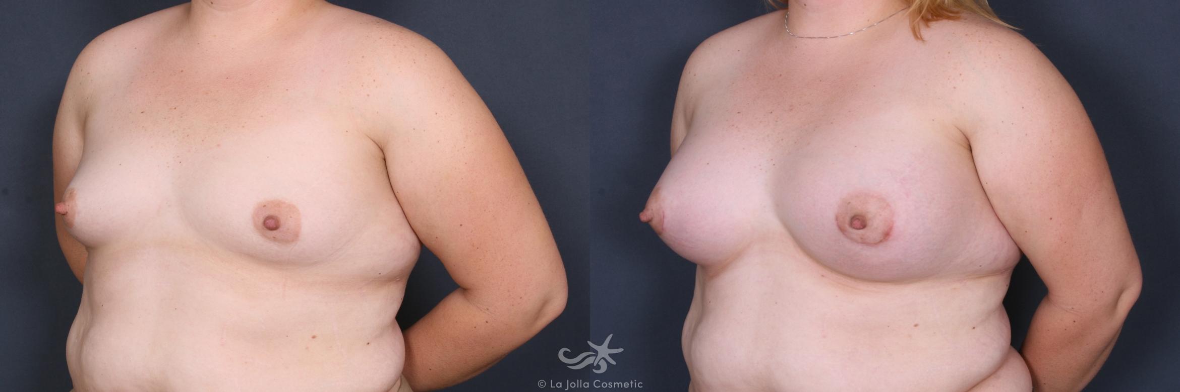 Before & After Breast Augmentation Result 333 Left Oblique View in San Diego, CA