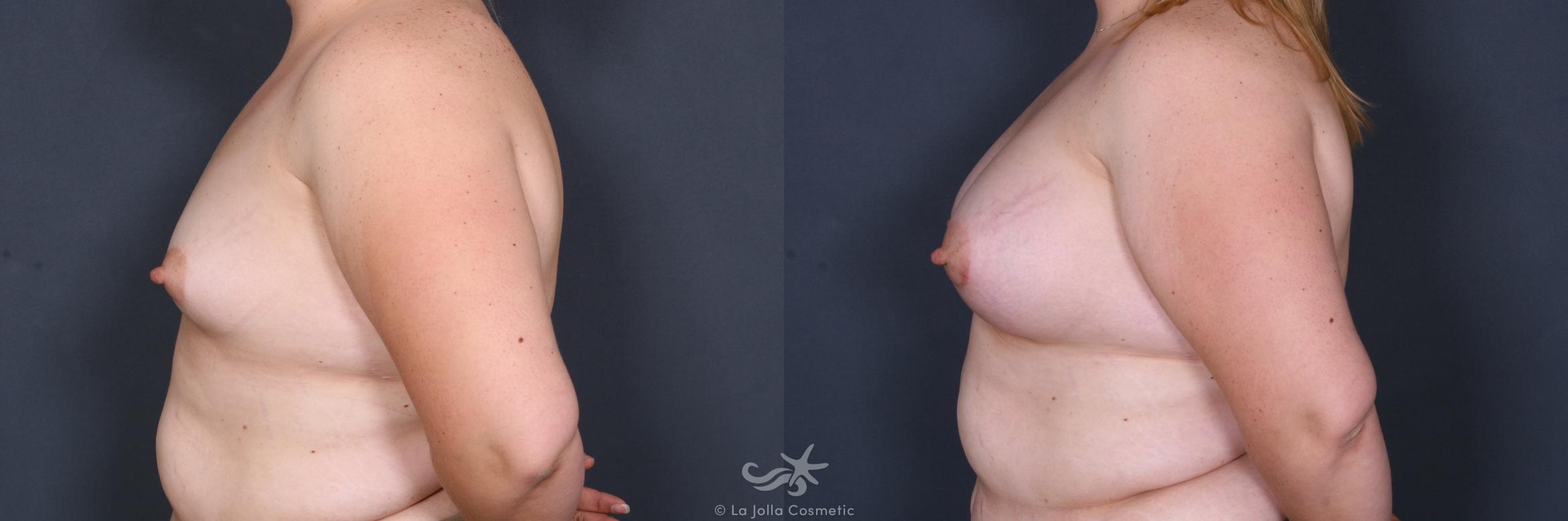 Before & After Breast Augmentation Result 333 Left Side View in San Diego, CA