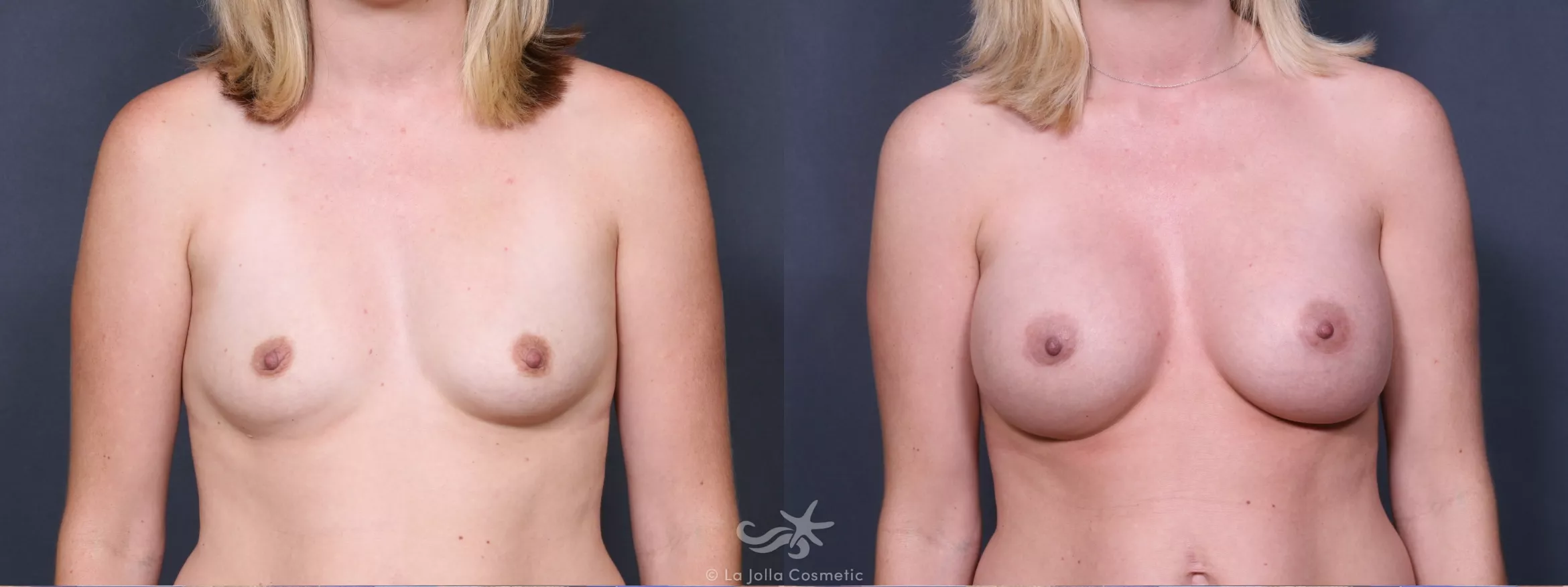 Before & After Breast Augmentation Result 334 Front View in San Diego, CA
