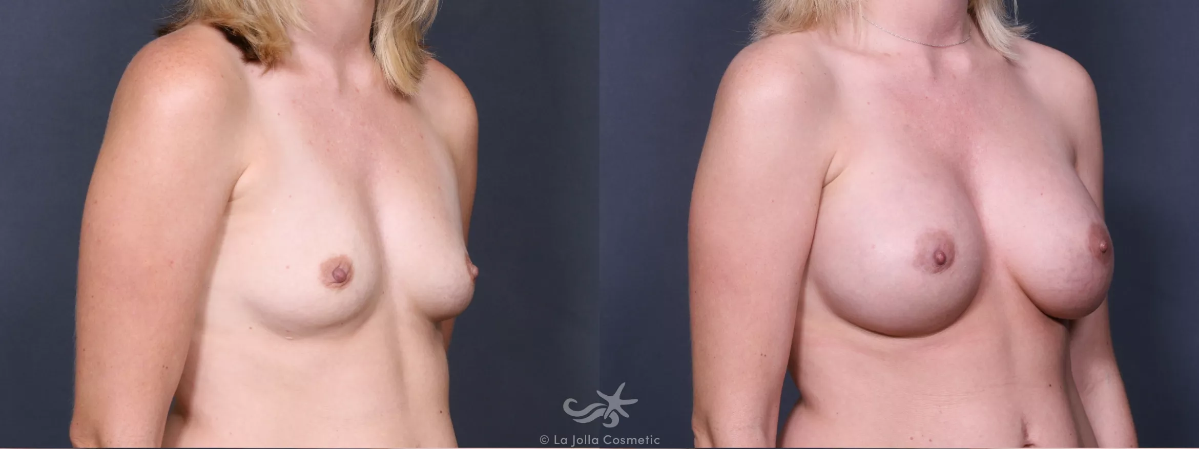 Before & After Breast Augmentation Result 334 Right Oblique View in San Diego, CA