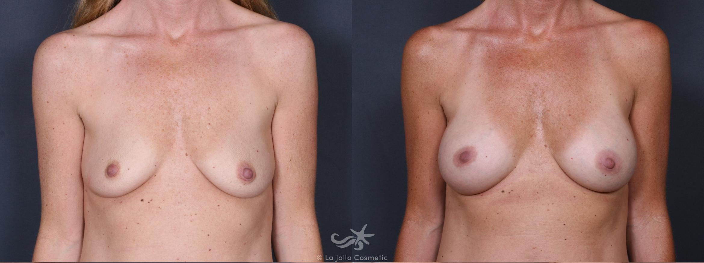 Before & After Breast Augmentation Result 337 Front View in San Diego, CA