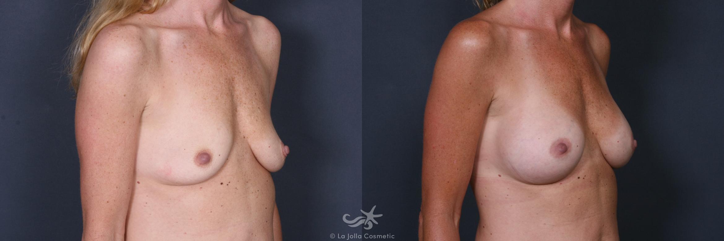 Before & After Breast Augmentation Result 337 Right Oblique View in San Diego, CA