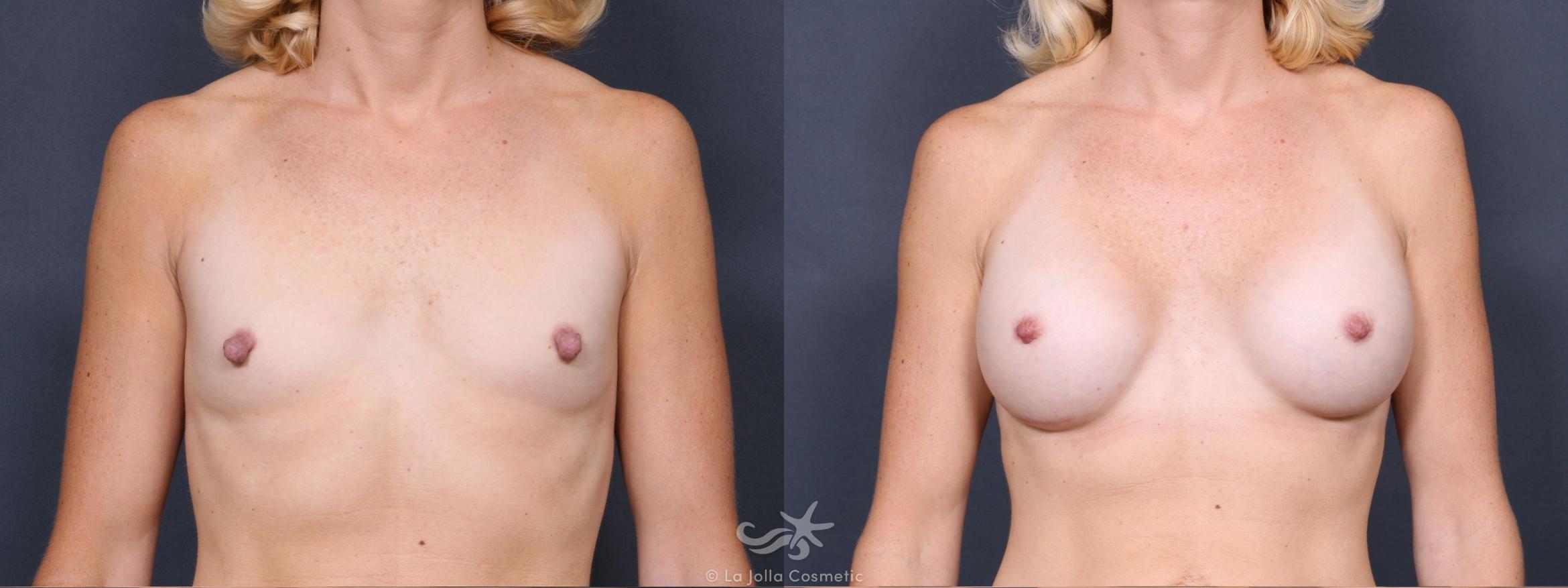 Before & After Breast Augmentation Result 338 Front View in San Diego, CA