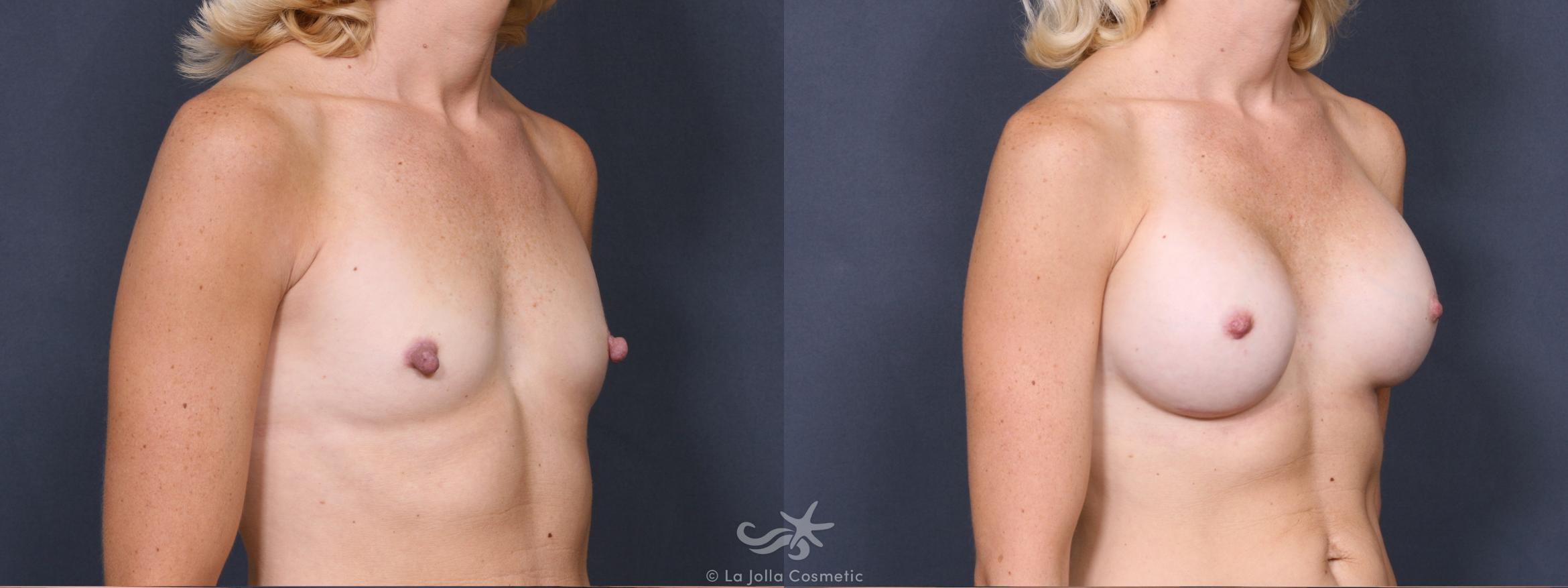 Before & After Breast Augmentation Result 338 Right Oblique View in San Diego, CA