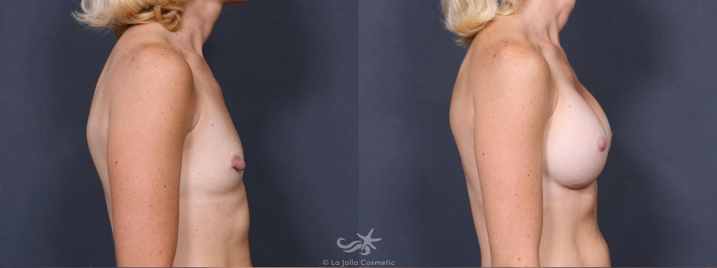 Before & After Breast Augmentation Result 338 Right Side View in San Diego, CA