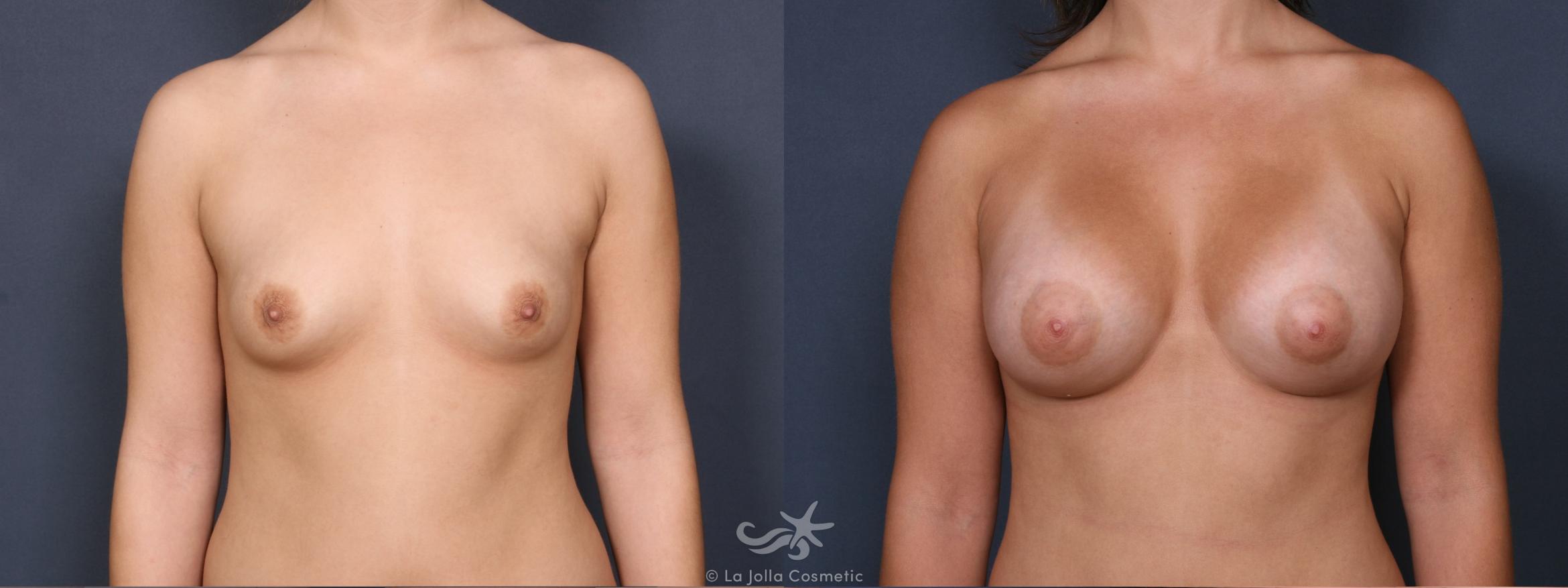 Before & After Breast Augmentation Result 339 Front View in San Diego, CA