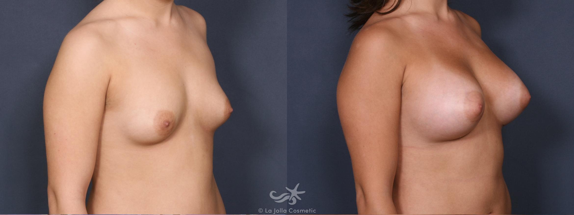 Before & After Breast Augmentation Result 339 Right Oblique View in San Diego, CA