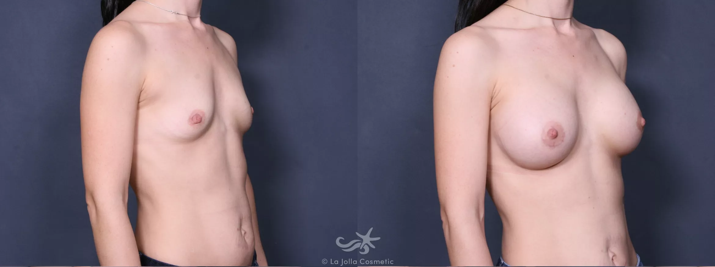 Before & After Breast Augmentation Result 341 Right Oblique View in San Diego, CA